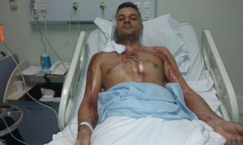 Motociclista se recupera após ser atingido por um raio em Jaguaruna